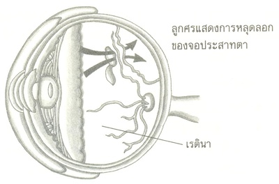 โรควุ้นในลูกตาเสื่อม